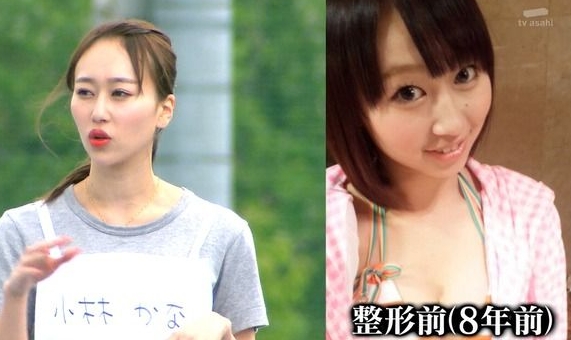 【エロ画像】小林香菜（元AKB48）がロンハーで整形カミングアウトでおっぱいもパンツも
